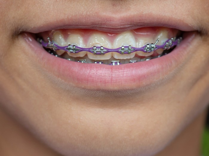 How Long Does It Take to Get Used to Braces?